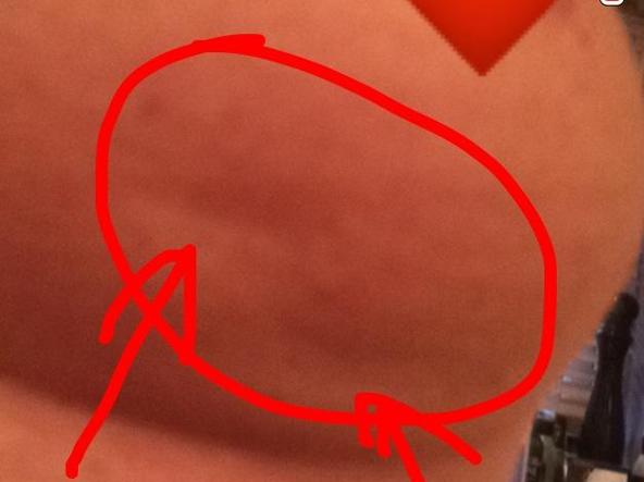 Facebook e il cancro al seno